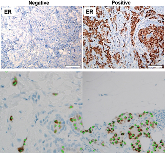 (top) negative (left) and positive (right) hormone receptor status of biopsies. (bottom) identified hormone receptor cells and indicated false positives 