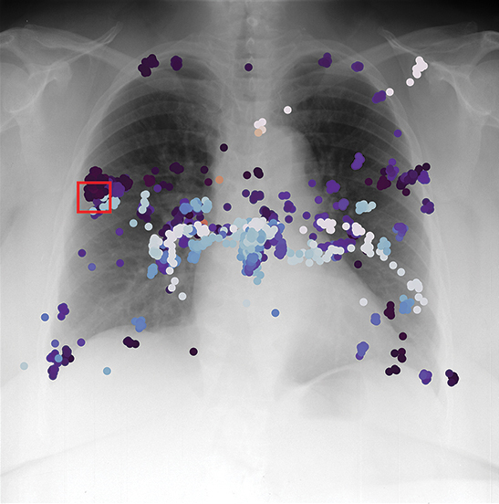Gaze points and area of interest plotted on lung x-ray