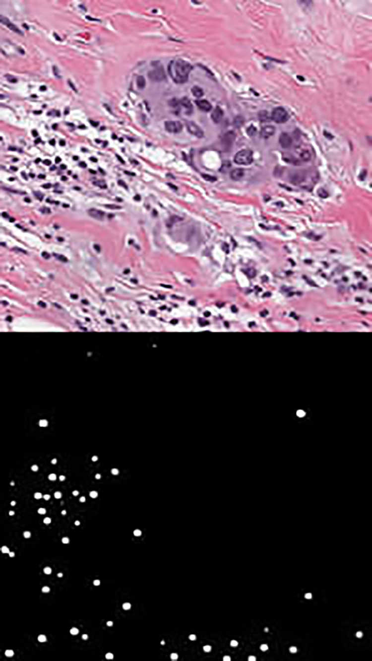 tumor sample (top) and cancer cells detected in that sample (bottom)