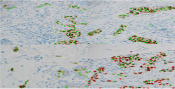 Estrogen receptor stained cells 