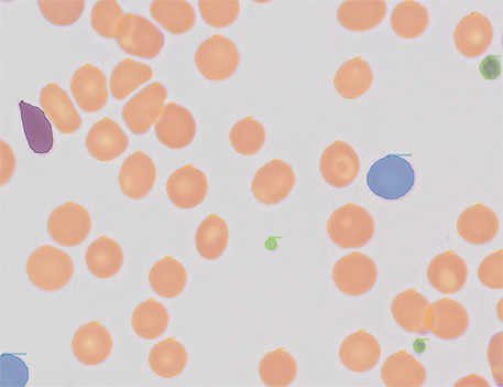 stained pathology slide with irregular blood cells indicating lymphoma.