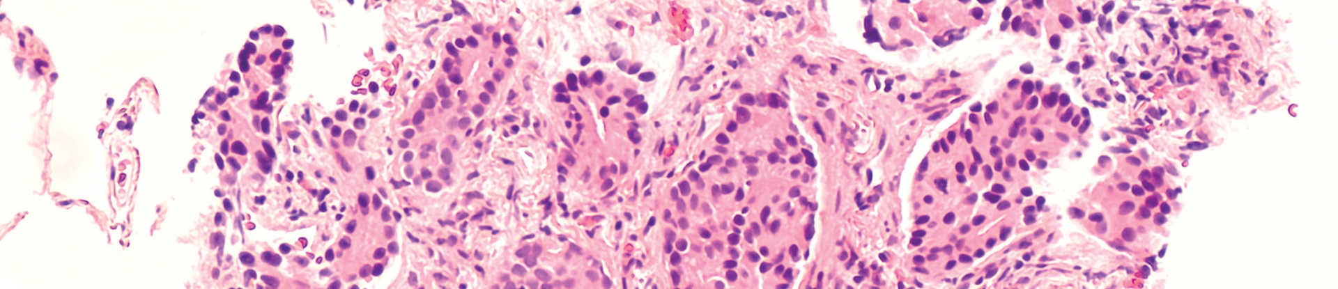 Photomicrograph of prostatic adenocarcinoma (prostate cancer) metastatic to lung