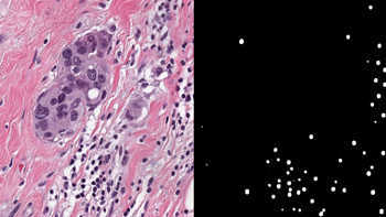 Side-by-side comparison of a tumor sample and cancer cells on a test slide